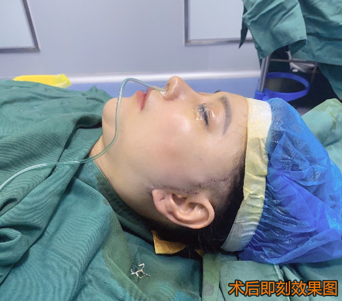 内窥镜无痕拉皮术,内窥镜脸部拉皮到底有多厉害