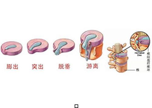 l5s1椎间盘突出康复训练方法,腰l5s1椎间盘右后方突出怎么锻炼