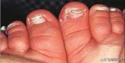 指甲有白点肚子里有蛔虫？月牙越大越健康？指甲软是缺钙……