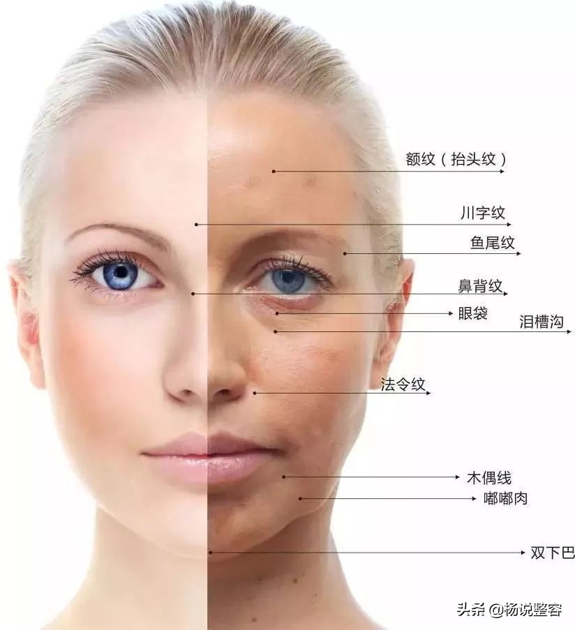 什么原因会导致法令纹越来越严重,脸上长了法令纹怎么淡化法令纹