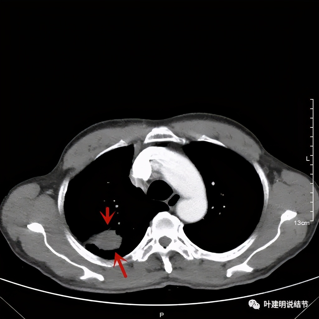 肺占位病理活检无病变,肺部占位穿刺病理说不确定性质