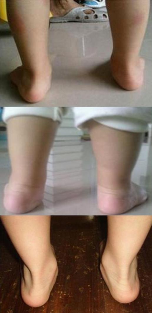 孩子足外翻通过训练可以痊愈吗,孩子轻微足外翻怎么办