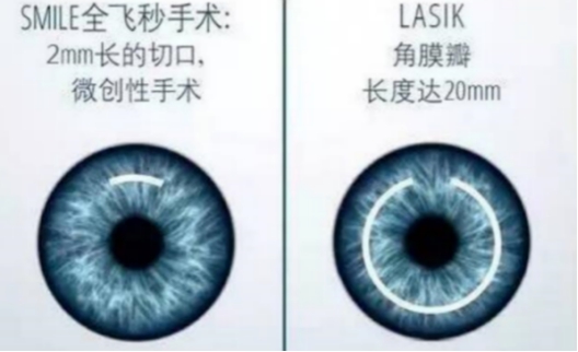 个体化半飞秒和标准化飞秒哪个好,个性化半飞秒技术和全飞秒哪个好