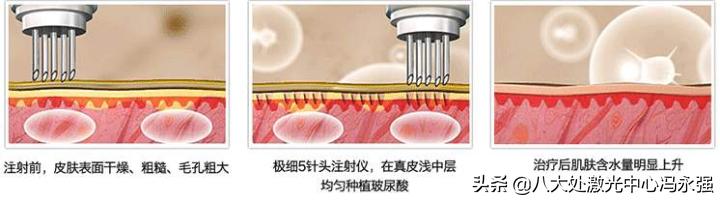 打了假的水光针有啥不良反应,什么是水光针有什么副作用