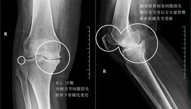 老人膝盖疼平时应怎么样康复锻炼,老年人膝盖后面肌肉疼痛怎么回事
