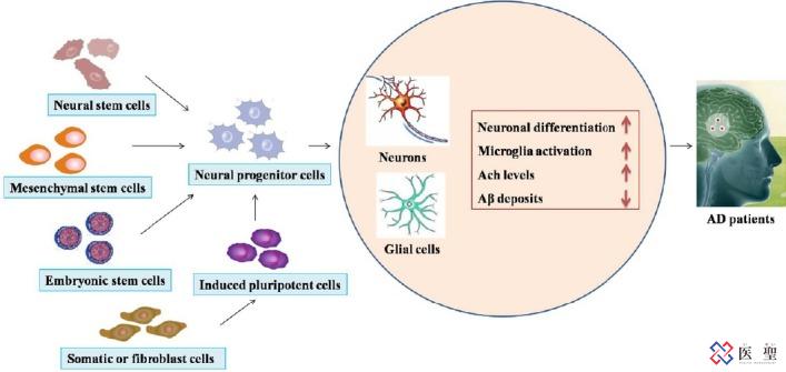 老年痴呆移植干细胞视频,老年痴呆回输干细胞有用吗