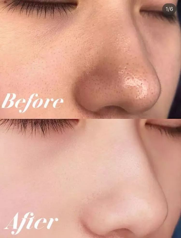 脸上螨虫多出油厉害怎么办,脸上螨虫过敏烂脸