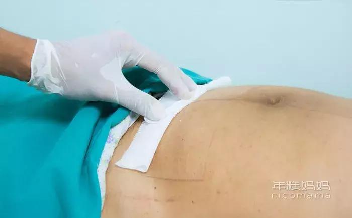 侧切一年有外伤和瘢痕疙瘩怎么办,顺产侧切伤口怎么护理伤口好得快