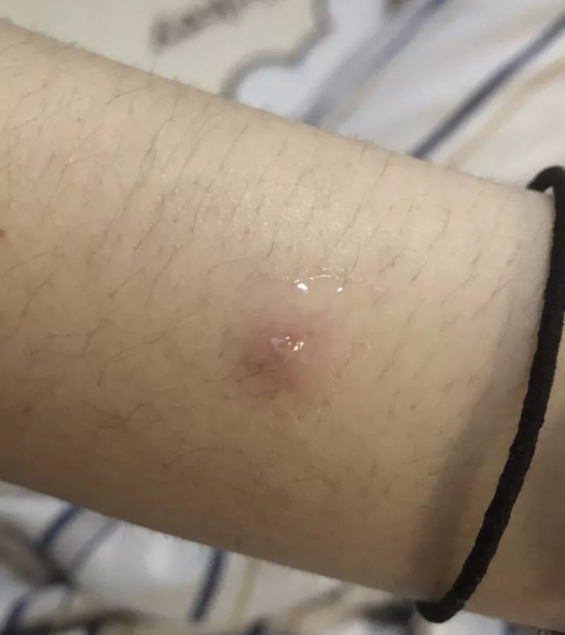 排痘效果好的药膏,祛痘排雷