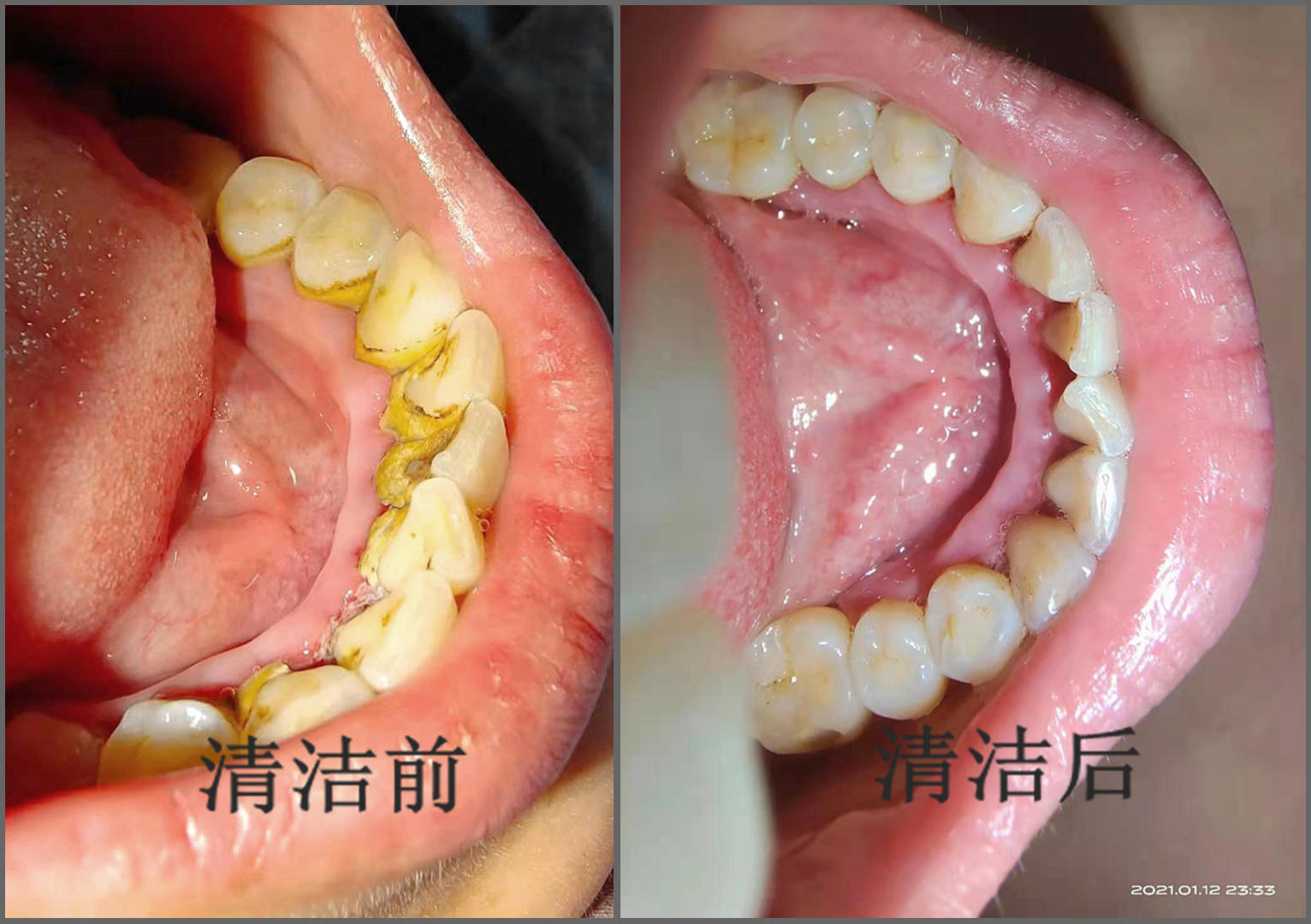 超声波洁牙器官方旗舰店,小米有品超声波洁牙仪