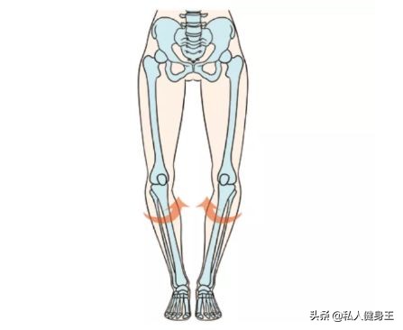 o型腿的原因与防治,o型腿的成因和危害