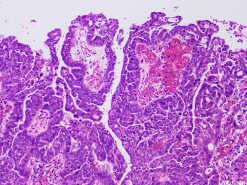 女子胸腔长奇怪肿瘤,女人胸腔积水