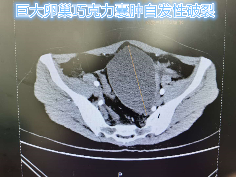 卵巢巧克力囊肿容易复发吗,卵巢巧克力囊肿容易恶化吗