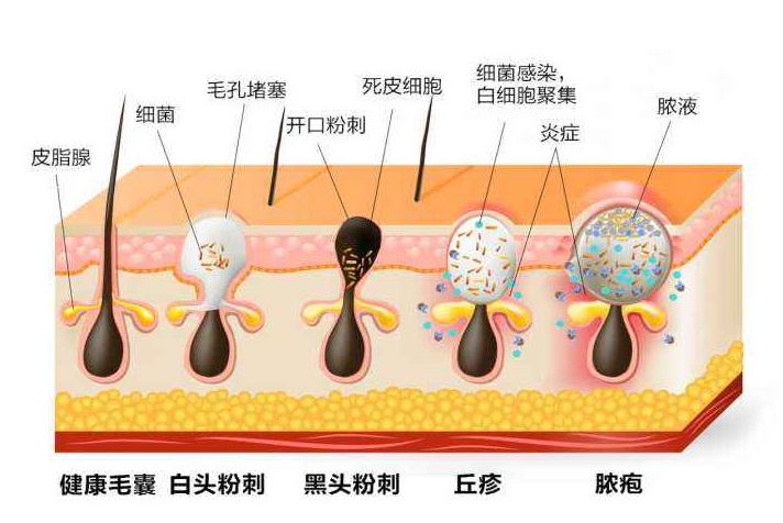关于各种痘痘的在线咨询,治疗痘痘的分享
