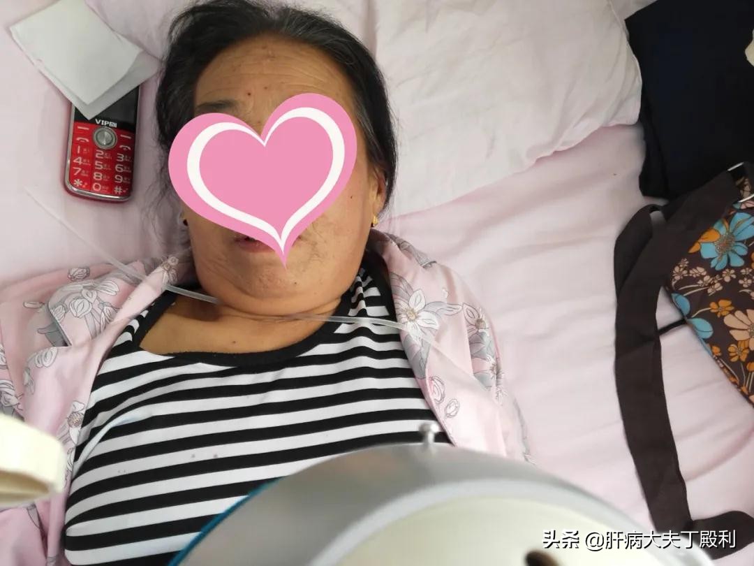 肝移植是治疗肝衰竭最好的手段,肝衰竭放弃肝移植