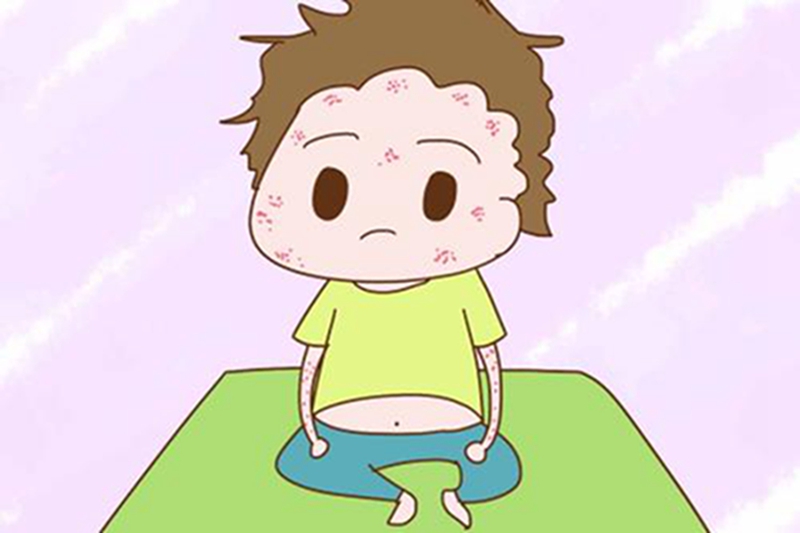 月嫂怎样解决宝宝湿疹问题,宝宝湿疹有妙招月嫂分享