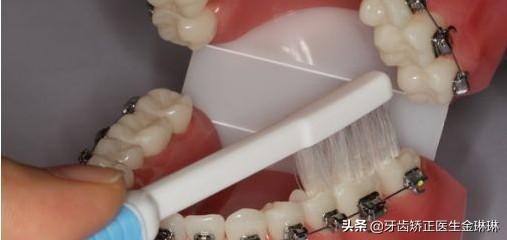 戴牙套能矫正兜齿吗,戴牙套会影响吐字不清吗