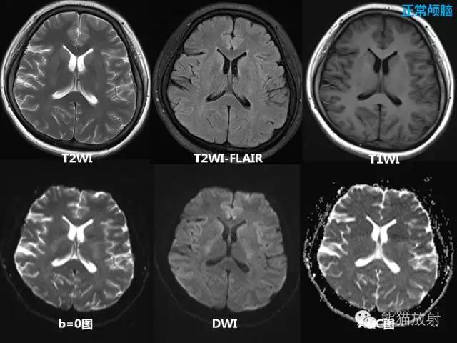 如何简单理解、认识MRI图像