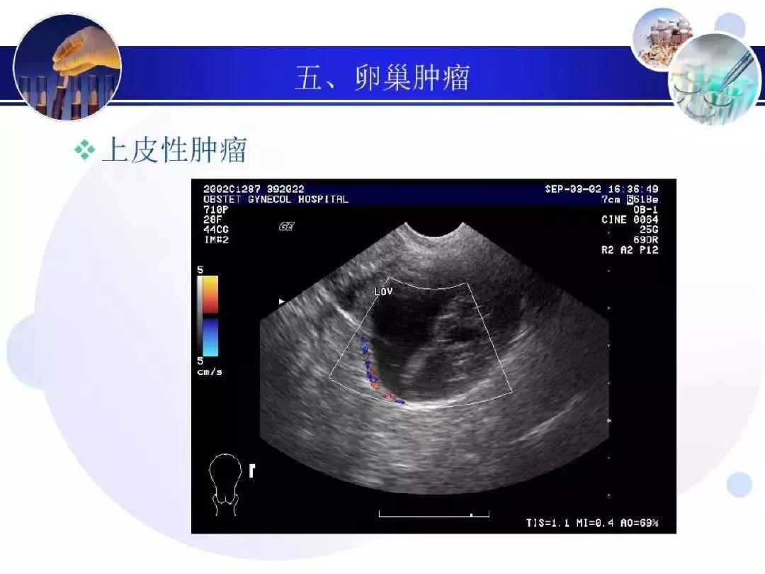 纯干货！子宫及附件解剖和超声诊断
