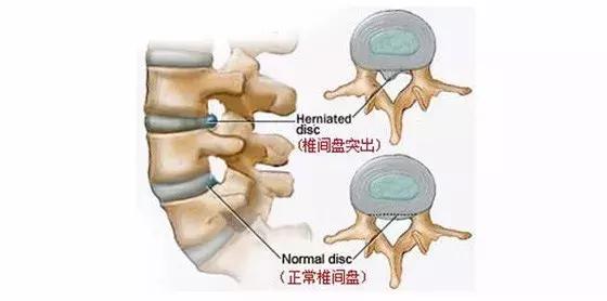 腰疼直不起来腰是什么原因引起的,青少年两侧腰疼是什么原因引起的