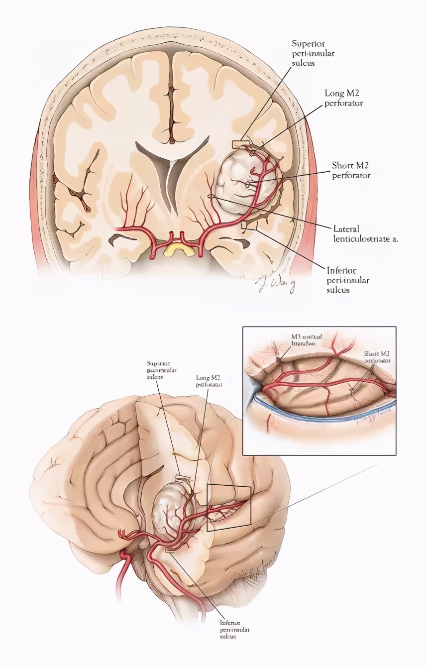 岛叶胶质瘤手术是开颅还是微创,岛叶良性胶质瘤复发率