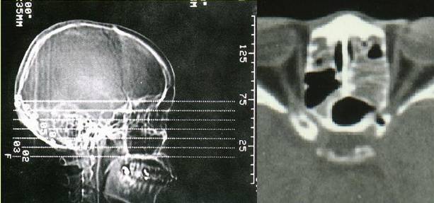 慢性鼻窦炎药物治疗原则,慢性鼻窦炎初步诊疗措施