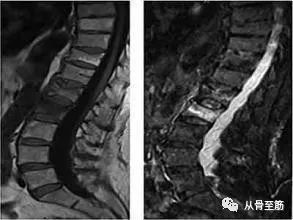 骨科小科普：“骨髓水肿”是什么意思？