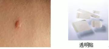 压疮敷料的选择及使用,褥疮敷料的正确使用方法