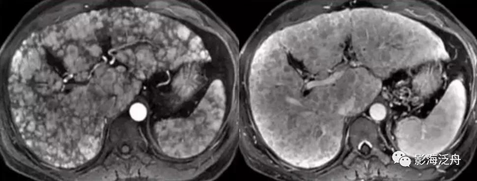 肝脏弥漫性病变严重吗,肝脏弥漫性的病变的症状