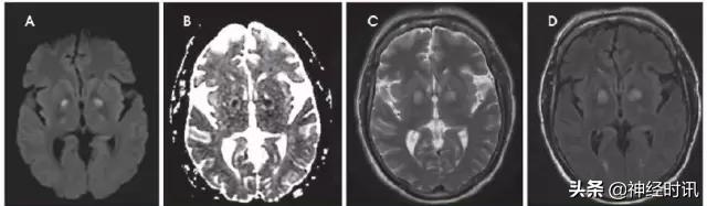 脑卒中病历诊断书图片,脑卒中影像判断技巧图解电子版