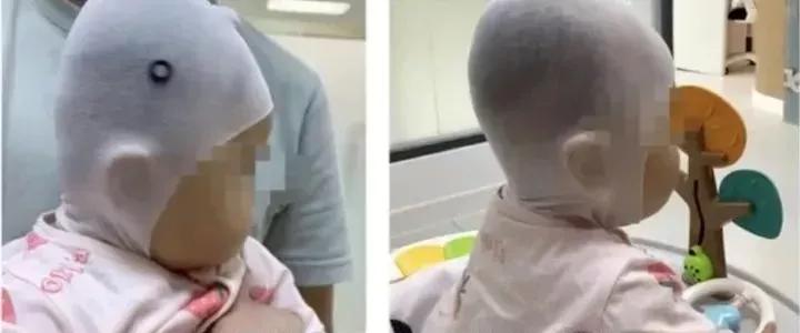 婴儿戴头盔矫正头型变畸形,婴儿戴摩托头盔