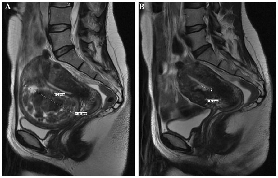 哪些子宫肌瘤介入栓塞后容易从阴道排出？