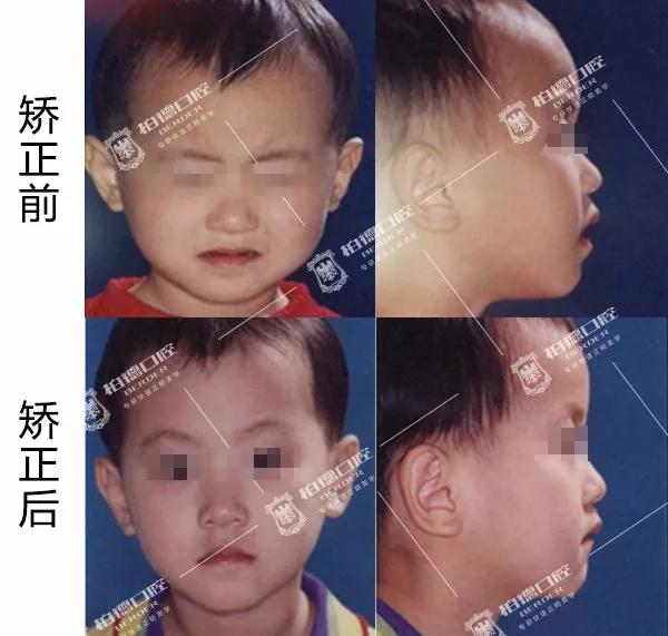 儿童牙齿早期干预矫正有几种,儿童牙齿早期矫正图片