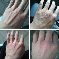 年年入冬脚就干裂有什么方法治好,想长寿养好背