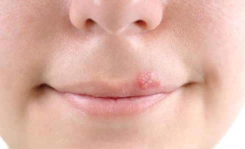 几块钱的罗红霉素管用吗,红霉素软膏多少钱有什么作用