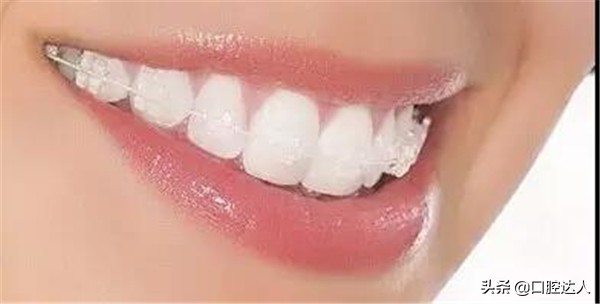 牙齿矫正的步骤,牙齿矫正怎么操作的