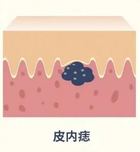 兽皮痣通过什么方式可以查出来,兽皮痣必须治疗吗