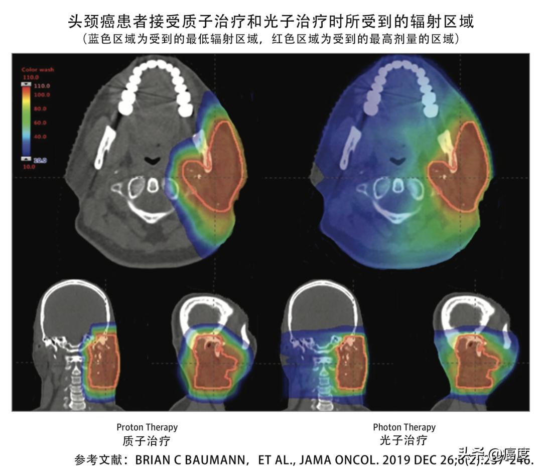 质子治疗能彻底治愈癌症吗,质子治疗靠什么杀死癌细胞