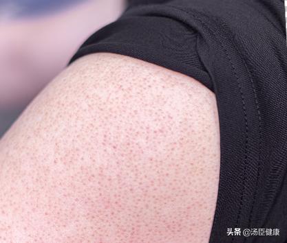 得了系统性红斑狼疮男朋友说分手,男生长了鸡皮肤