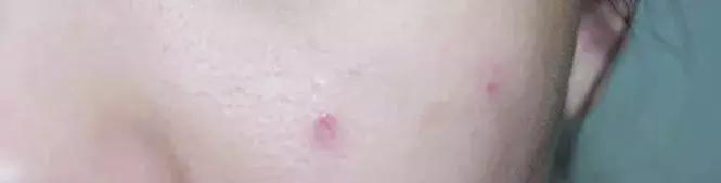 黑头闭口粉刺怎么去除,黑头粉刺怎么去都消除不了