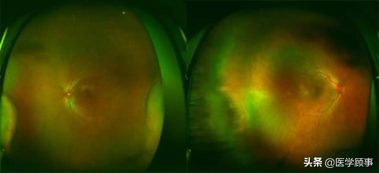 小柳原田综合征需要配眼镜吗,小柳原田综合征是罕见病吗