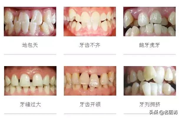 2020牙齿矫正攻略请查收,今日头条修复牙齿