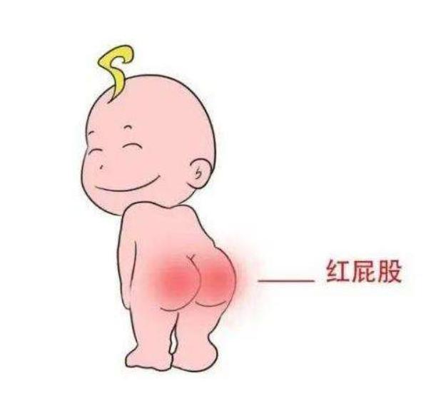 宝宝红屁股尿布疹了怎么办,尿布疹红屁股用什么药