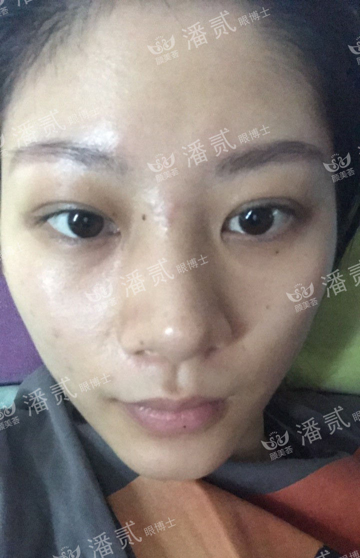 肿眼泡抽脂肪埋线双眼皮效果,肿眼泡割双眼皮长脂肪