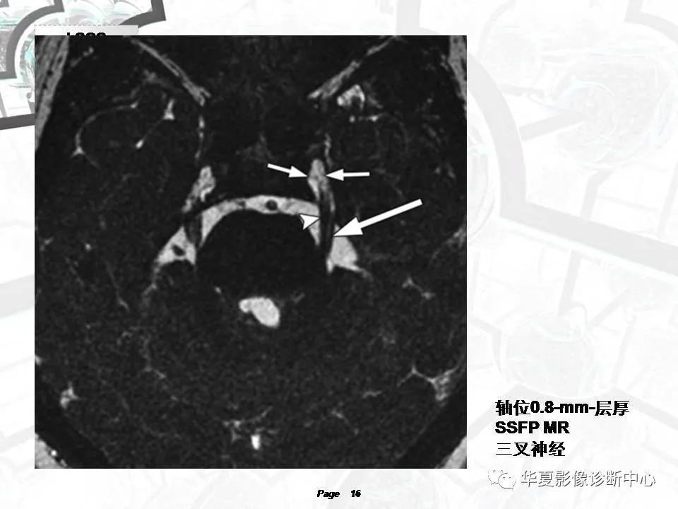 磁共振颅神经扫描是定位在哪,颅神经图谱