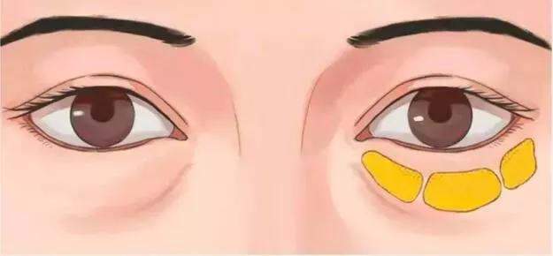 眼袋怎么消除简单方法男生,黑眼袋怎么消除最快方法男士