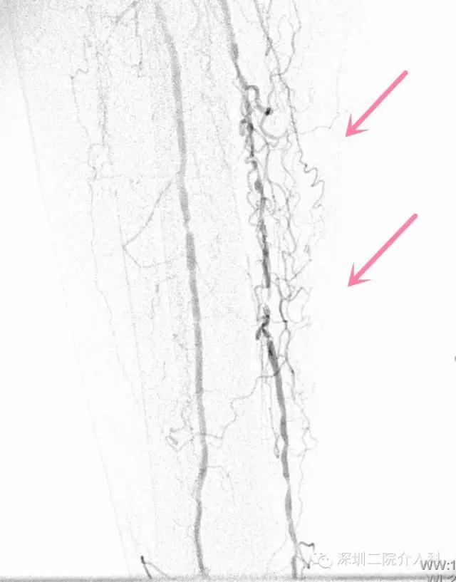 糖尿病下肢血管病变介入治疗,糖尿病足血管介入