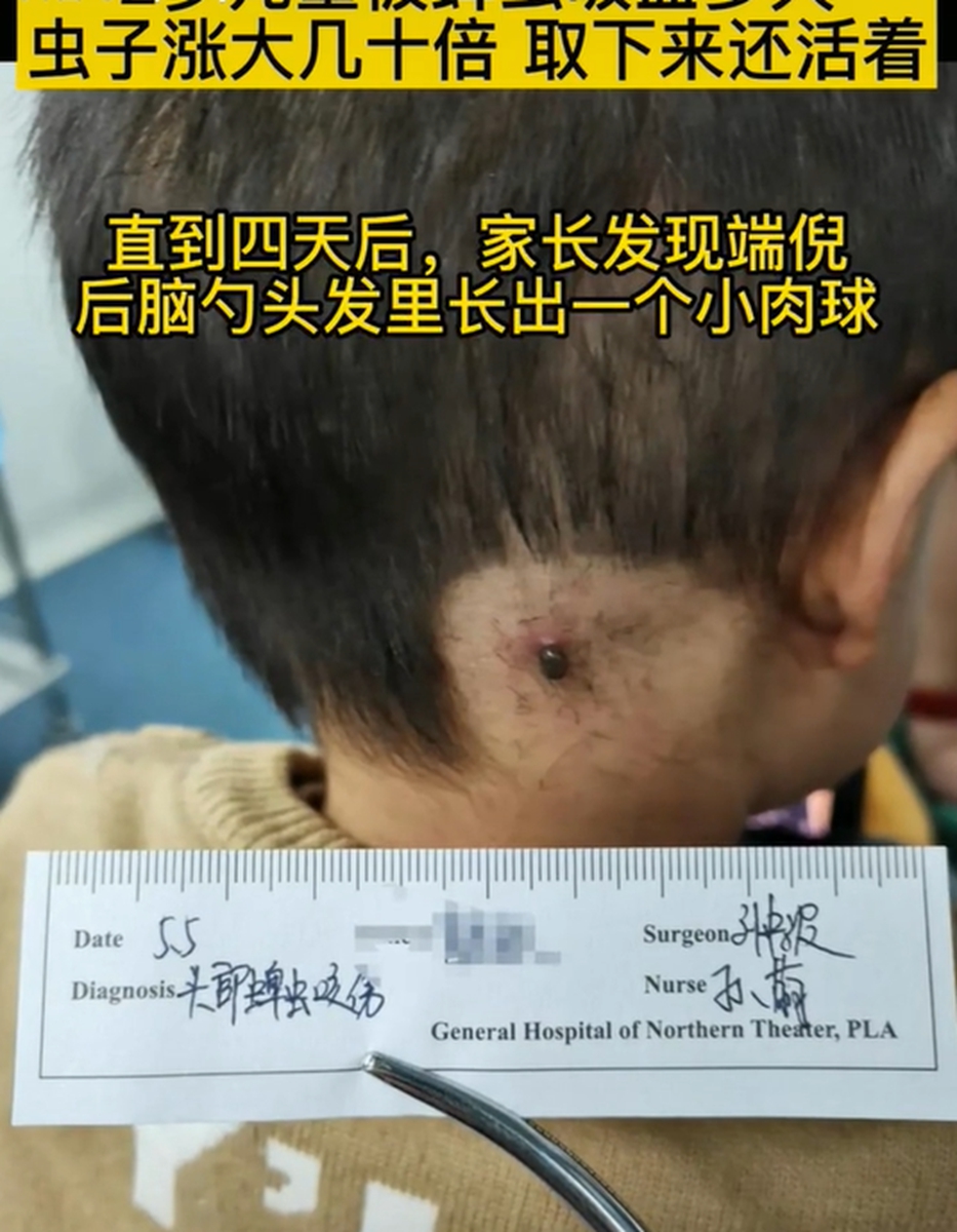 孩子被蜱虫咬头不长头发了,2岁宝宝被蜱虫咬后会哭闹吗