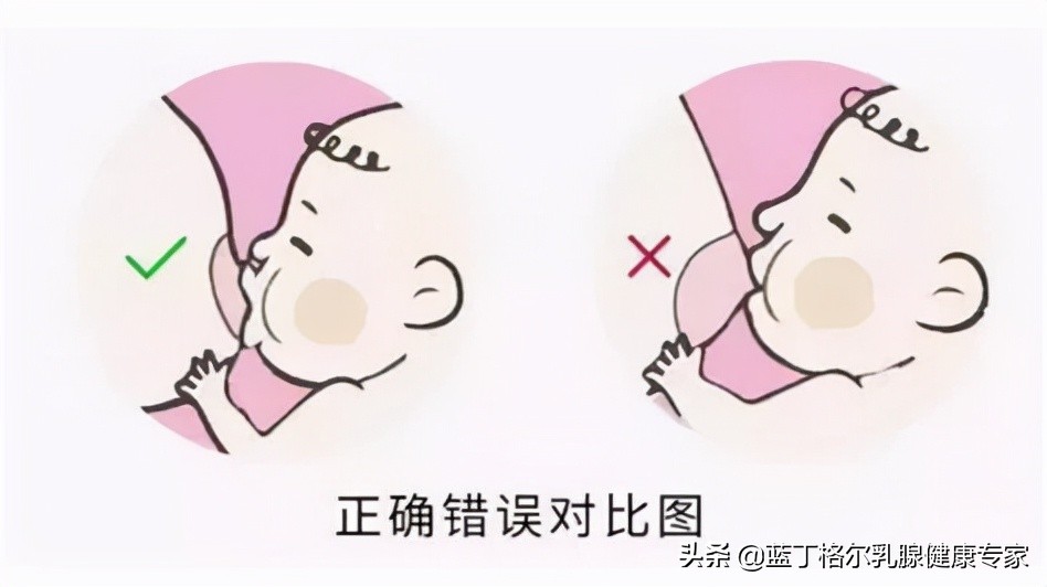 哺乳期容易出现的乳房疾病,哺乳期女人存在哪些问题