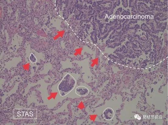 肺癌气道播散转移的症状,肺癌胸膜腔转移